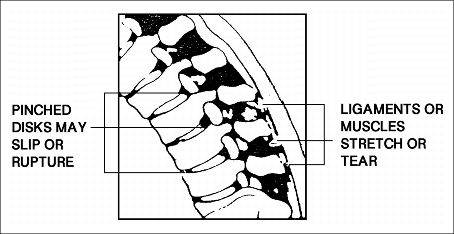 Spine showing pinched vertebrae.