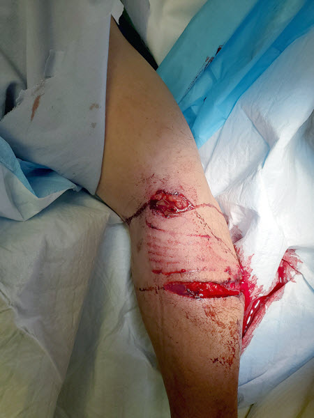 Public Health Warning:
Pit Bull Attacks